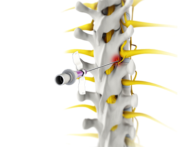 Radiofrequency Ablation - Educational Photo