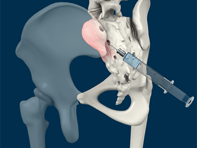Sacroiliac Joint Injections - Educational Photo