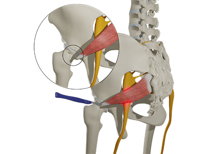 Sacral Nerve Compression - Educational Photo
