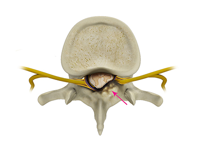 Spinal Stenosis - Educational Photo