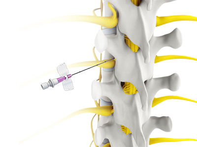 Spine Injections - Educational Photo