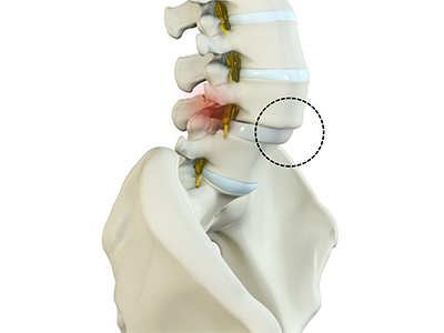 Spondylolisthesis - Educational Photo