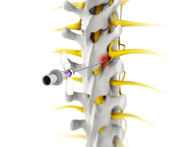 Thoracic Facet Radiofrequency Ablation - Educational Photo