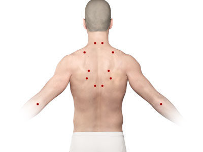 Trigger Point Injections - Educational Photo