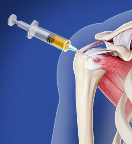 Orthobiologics - Educational Photo