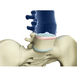 Anterior Lumbar Interbody Fusion pic
