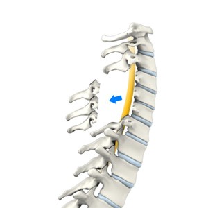 Cervical Laminectomy pic