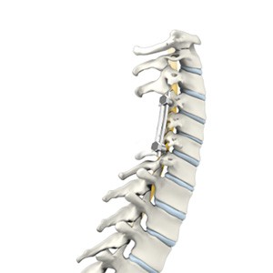 Cervical Spine Fusion pic
