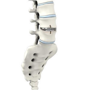 Lumbar Artificial Disc Replacement pic