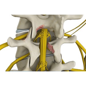 Lumbar Decompression pic
