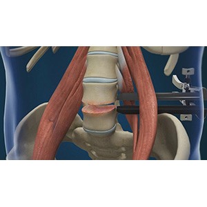 Lumbar Discectomy pic