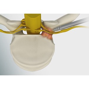 Lumbar Foraminotomy pic