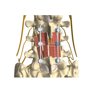 Lumbar Fusion Procedures pic
