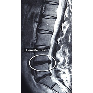 Lumbar Disc Herniation pic
