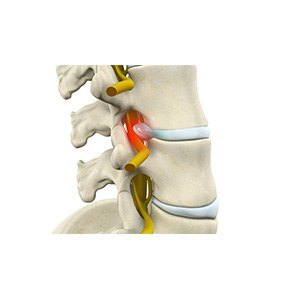 Lumbar Radiculopathy pic