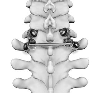 Motion Preservation Surgery pic