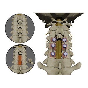 Posterior Cervical Decompression pic