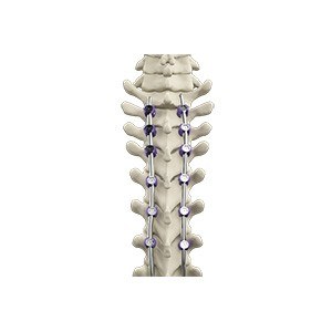 Scoliosis pic