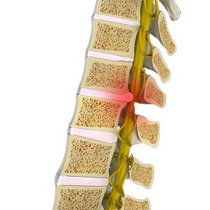 Spinal Cord Compression pic