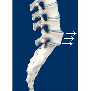 Spinal Instability pic