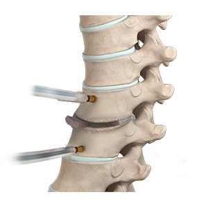 Thoracic Discectomy pic
