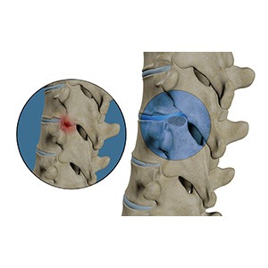 Thoracic Facetectomy pic