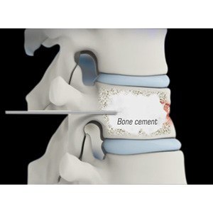 Thoracic Kyphoplasty pic