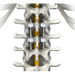 Thoracic Spine Fusion pic