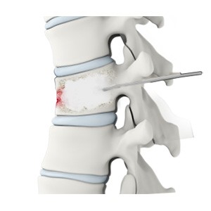 Thoracic Vertebroplasty pic