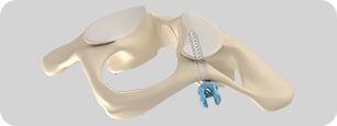 Biomechanical comparison Pic