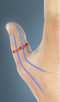 Microvascular Surgery