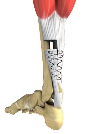 Tendon Repair Surgery pic