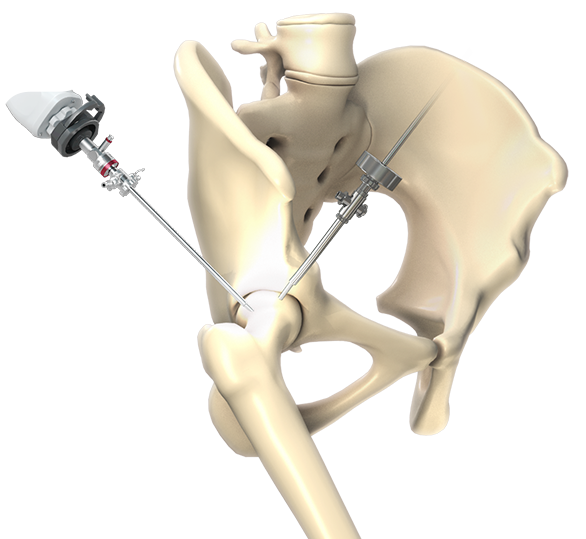 Hip Arthroscopy Img