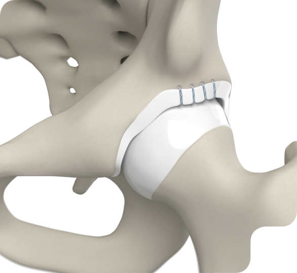 Hip Labrum Reconstruction Img