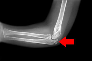 Adolescent Elbow Injuries