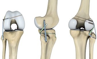 Ligament Preservation/Repair