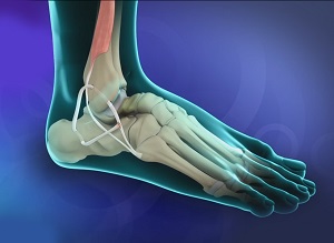 Ligament Reconstruction