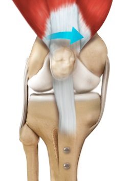 Patella Stabilization