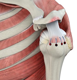 Rotator Cuff Repair