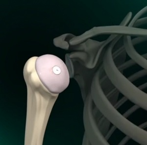 Shoulder Cartilage Restoration