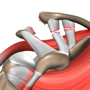 Acromioclavicular Joint Dislocation (Shoulder Separation)