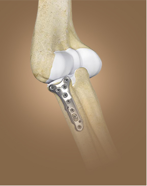 Elbow Fracture Repair - Specialties