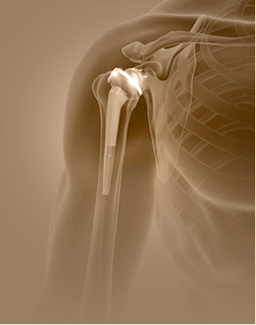 Reverse Shoulder Replacement - Specialties