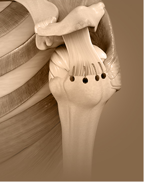 Rotator Cuff Repair - Specialties