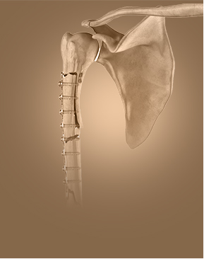 Shoulder Fracture Repair - Specialties