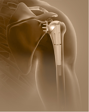 Shoulder Replacement - Specialties