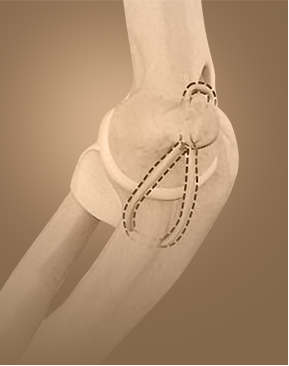 Elbow UCL Reconstruction - Specialties