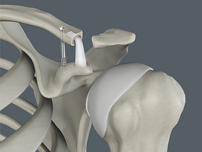Acromioclavicular (AC) Joint Reconstruction