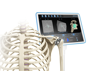 Computer Navigation for Shoulder Replacement