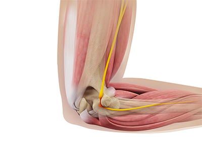 Cubital Tunnel Syndrome (Ulnar Nerve Entrapment)